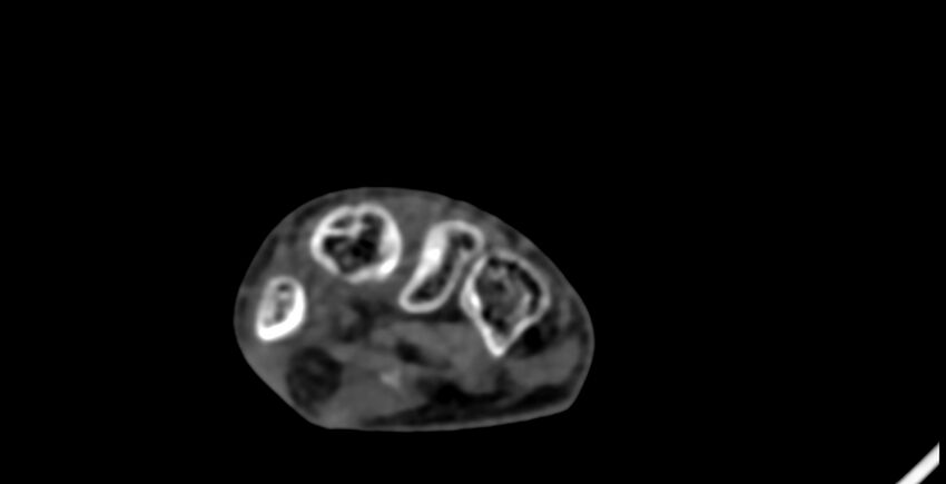 Calcifying aponeurotic fibroma (Radiopaedia 88423-105064 B 110).jpg