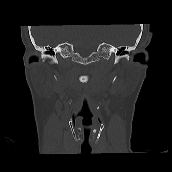 File:Canal up mastoidectomy (Radiopaedia 78108-90638 Coronal bone window 32).jpg