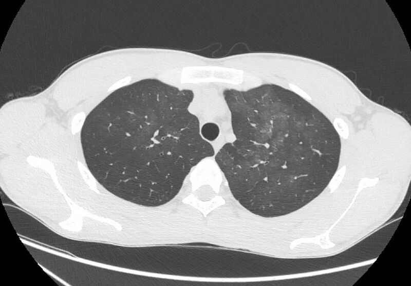 File:Cannabis-induced diffuse alveolar hemorrhage (Radiopaedia 89834-106946 Axial lung window 25).jpg