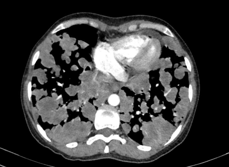 File:Cannonball metastases from breast cancer (Radiopaedia 91024-108569 A 92).jpg