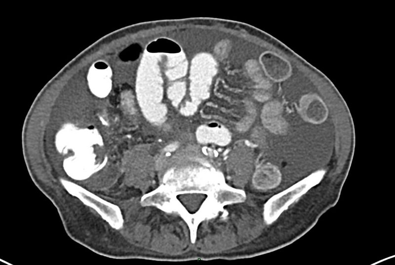 File:Carcinoid mesenteric tumor complicated by chylous ascites (Radiopaedia 76312-87953 A 48).jpg