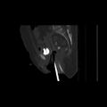 Carcinoma cervix- brachytherapy applicator (Radiopaedia 33135-34173 Sagittal bone window 93).jpg