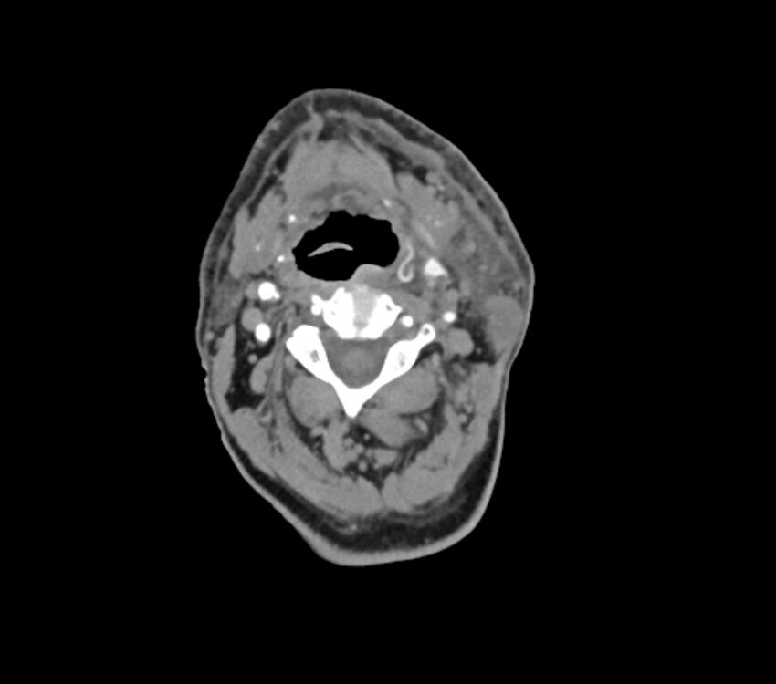 Carotid artery pseudoaneurysm (Radiopaedia 84030-99259 C 33).jpg