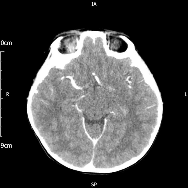 File:Cavernous sinus thrombosis (Radiopaedia 79414-92510 Axial Brain 94).jpg