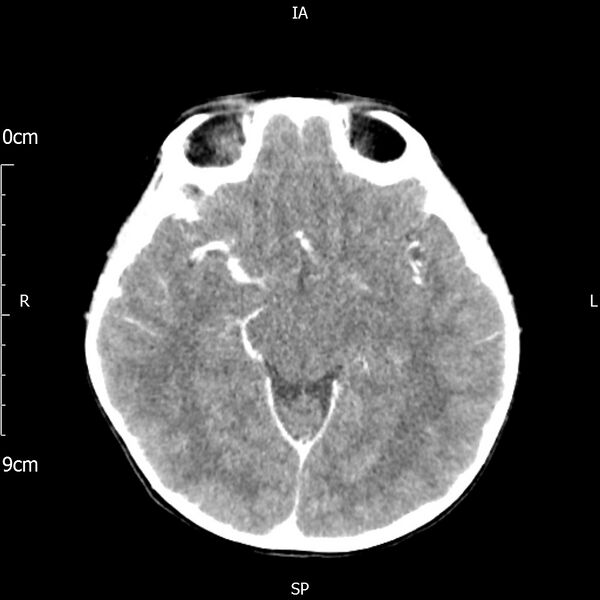 File:Cavernous sinus thrombosis (Radiopaedia 79414-92510 Axial Brain 95).jpg