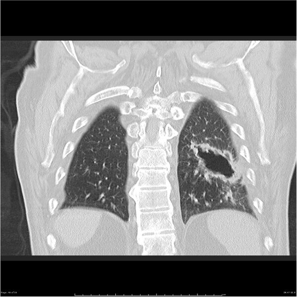 File:Cavitating left lower lobe lesion - squamous cell lung cancer (Radiopaedia 27749-28176 Coronal lung window 46).jpg