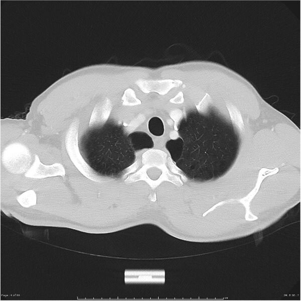 File:Cavitating lung cancer (Radiopaedia 25796-25945 Axial lung window 4).jpg