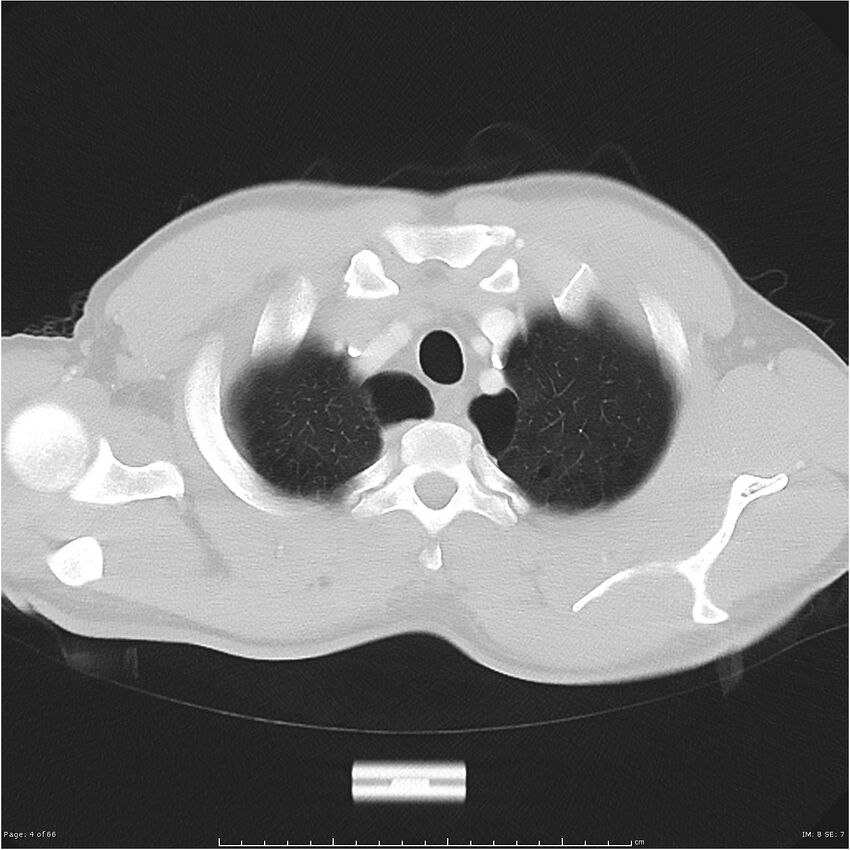 Cavitating lung cancer (Radiopaedia 25796-25945 Axial lung window 4).jpg