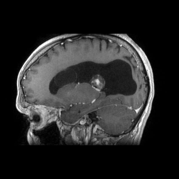 File:Central neurocytoma (Radiopaedia 67618-77021 Sagittal T1 C+ 19).jpg