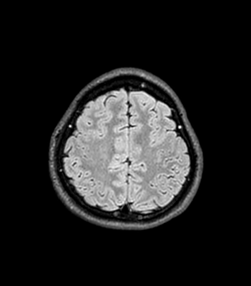 Central neurocytoma (Radiopaedia 79320-92380 Axial FLAIR 77).jpg