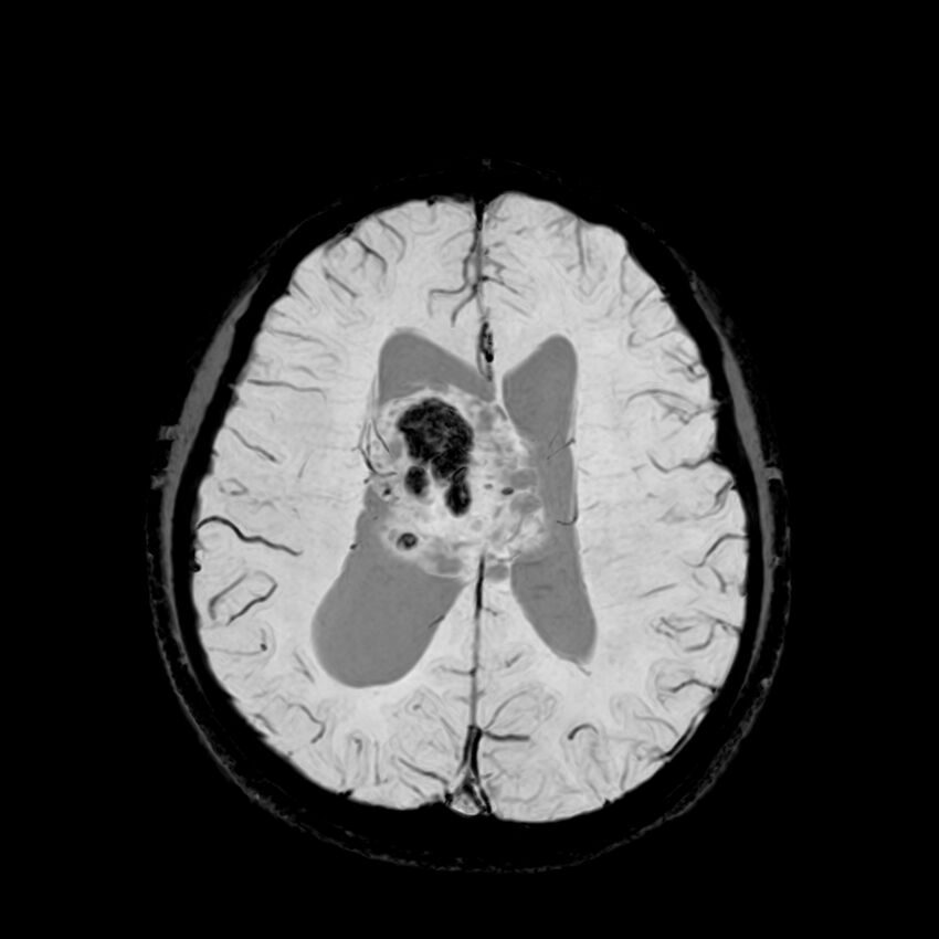 Central neurocytoma (Radiopaedia 79320-92380 Axial SWI 91).jpg