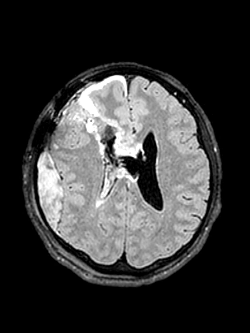 Central neurocytoma (Radiopaedia 79320-92381 Axial FLAIR 69).jpg