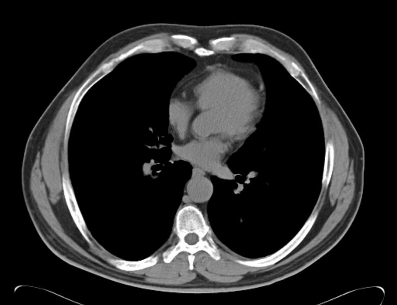 File:Centrilobular pulmonary emphysema (Radiopaedia 26808-26971 Axial non-contrast 26).jpg