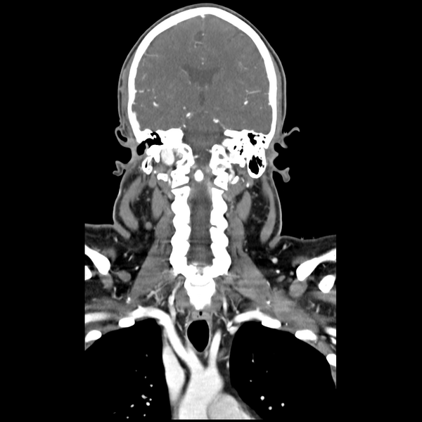File:Cerebellar infarct due to vertebral artery dissection with posterior fossa decompression (Radiopaedia 82779-97029 D 33).png