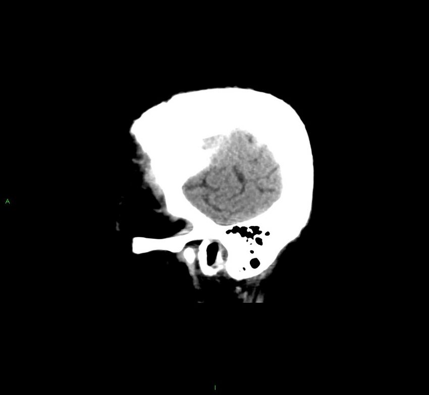 Cerebral amyloid angiopathy-associated lobar intracerebral hemorrhage (Radiopaedia 58376-65511 C 48).jpg
