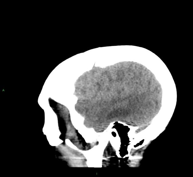 File:Cerebral amyloid angiopathy-associated lobar intracerebral hemorrhage (Radiopaedia 58379-65519 C 44).jpg
