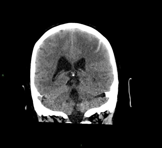 File:Cerebral amyloid angiopathy-associated lobar intracerebral hemorrhage (Radiopaedia 58529-65681 Coronal non-contrast 26).jpg