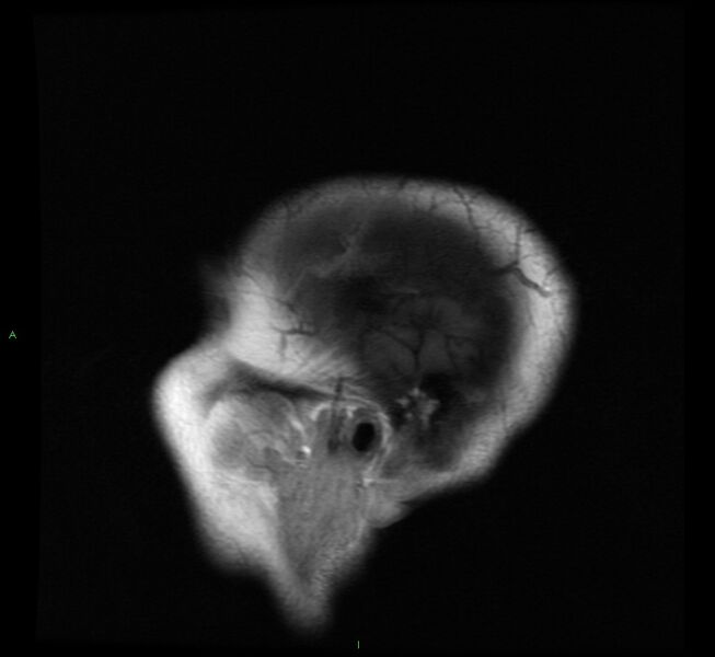 File:Cerebral amyloid angiopathy-associated lobar intracerebral hemorrhage (Radiopaedia 58529-65684 Sagittal T1 22).jpg