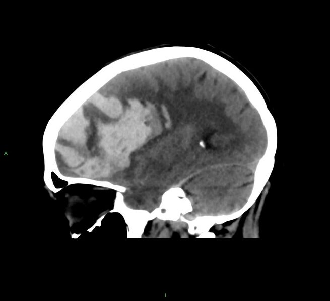 File:Cerebral amyloid angiopathy-associated lobar intracerebral hemorrhage (Radiopaedia 58561-65724 C 33).jpg