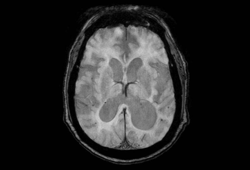 File:Cerebral amyloid angiopathy (Radiopaedia 86671-102792 Axial Gradient Echo 25).jpg