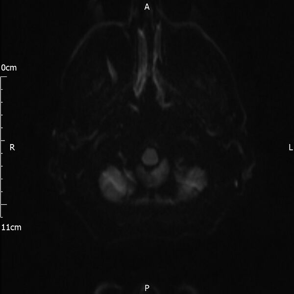 File:Cerebral amyloid angiopathy related inflammation (Radiopaedia 72772-83415 Axial DWI 26).jpg