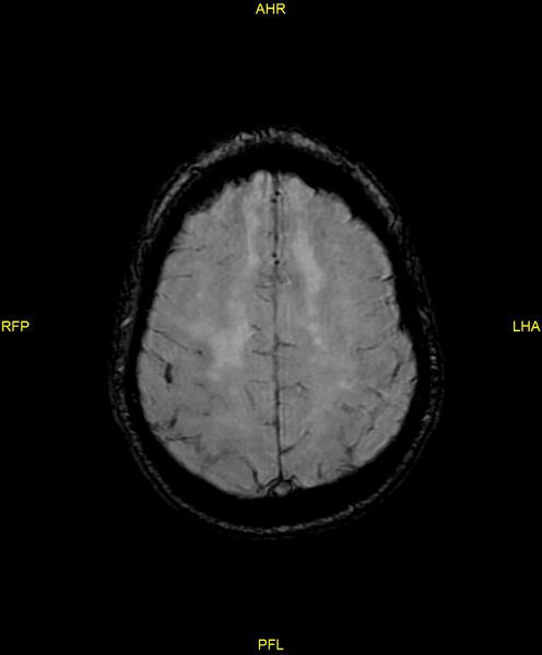 File:Cerebral autosomal dominant arteriopathy with subcortical infarcts and leukoencephalopathy (CADASIL) (Radiopaedia 86108-102054 Axial SWI 83).jpg