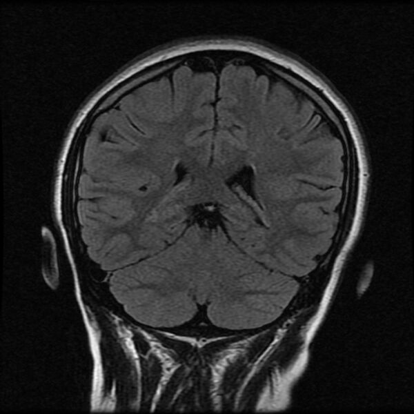 File:Cerebral cavernous malformation (Radiopaedia 44301-47942 Coronal FLAIR 17).jpg