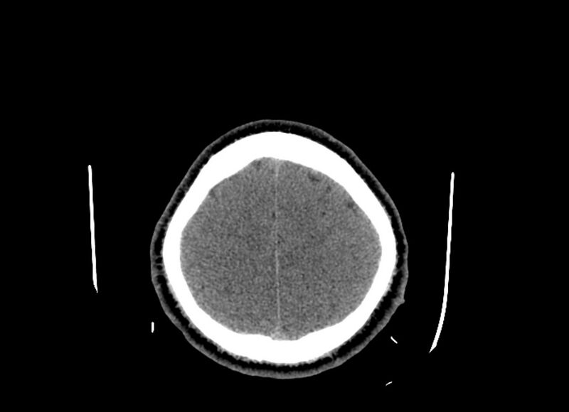 File:Cerebral edema (Radiopaedia 82519-96661 Axial non-contrast 11).jpg