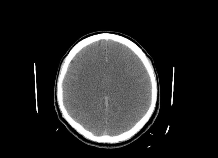 Cerebral edema (Radiopaedia 82519-96661 Axial non-contrast 20).jpg