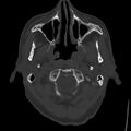 Cerebral hemorrhagic contusions (Radiopaedia 23145-23188 Axial bone window 3).jpg