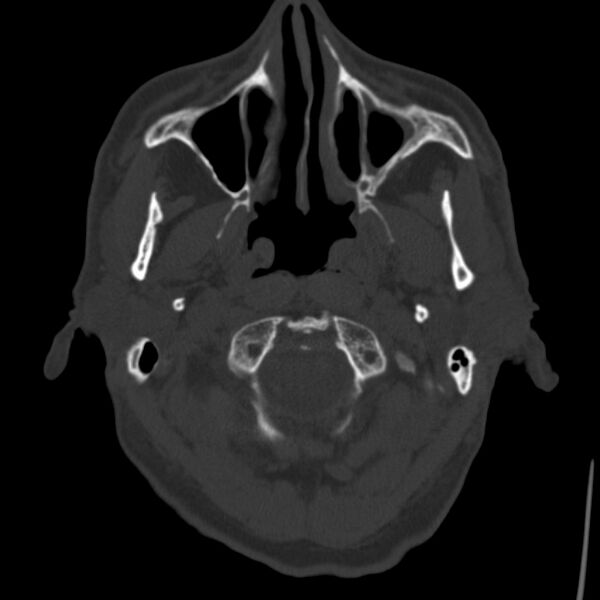 File:Cerebral hemorrhagic contusions (Radiopaedia 23145-23188 Axial bone window 3).jpg
