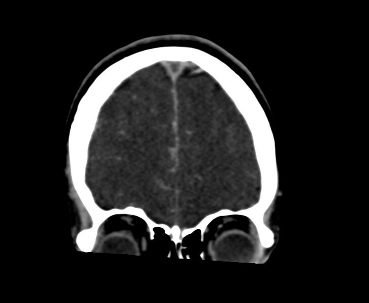 File:Cerebral venous sinus thrombosis (Radiopaedia 59224-66646 Coronal C+ delayed 12).jpg