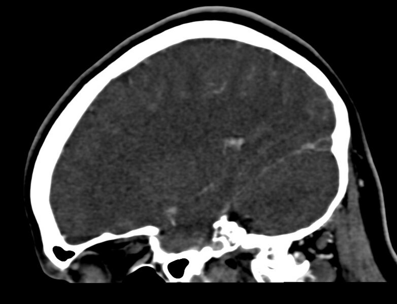 File:Cerebral venous sinus thrombosis (Radiopaedia 59224-66646 Sagittal C+ delayed 41).jpg