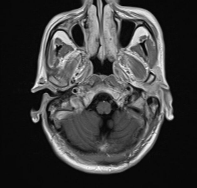 File:Cerebral venous thrombosis (Radiopaedia 71207-81504 Axial T1 C+ 4).jpg