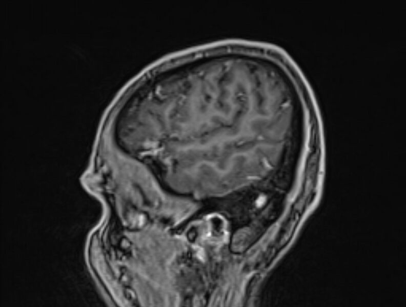 File:Cerebral venous thrombosis (Radiopaedia 71207-81504 Sagittal T1 C+ 57).jpg