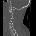 Cervical flexion teardrop fracture with cord hemorrhage (Radiopaedia 32497-33454 Sagittal bone window 30).jpg