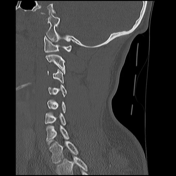 File:Cervical flexion teardrop fracture with cord hemorrhage (Radiopaedia 32497-33454 Sagittal bone window 30).jpg