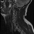 Cervical flexion teardrop fracture with cord hemorrhage (Radiopaedia 32497-33455 Sagittal T2 1).jpg
