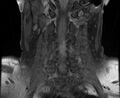 Cervical schwannoma (Radiopaedia 72399-82934 G 8).jpg