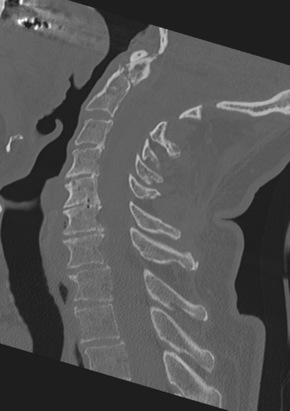 File:Cervical spine fractures with vertebral artery dissection (Radiopaedia 53296-59268 Sagittal bone window 33).png