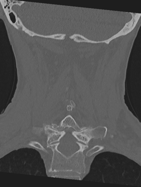 File:Cervical spondylolysis (Radiopaedia 49616-54811 Coronal bone window 39).png