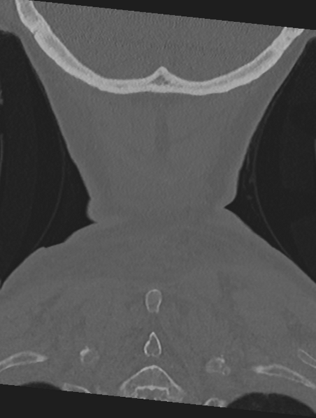File:Cervical spondylolysis (Radiopaedia 49616-54811 Coronal bone window 60).png