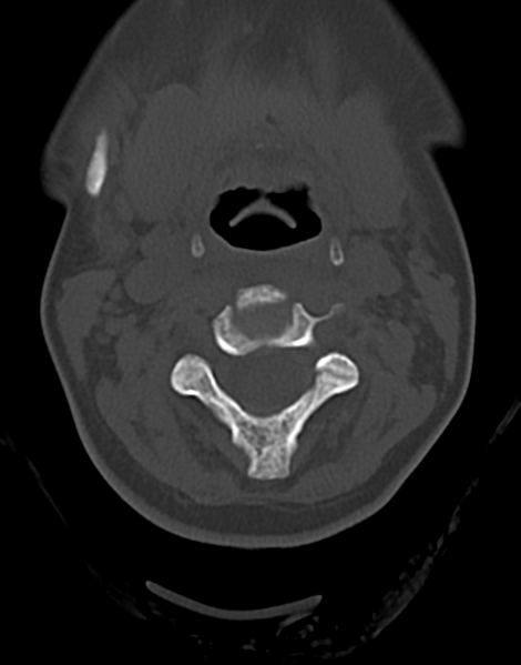 File:Cervical tuberculous spondylitis (Radiopaedia 39149-41365 Axial bone window 20).png