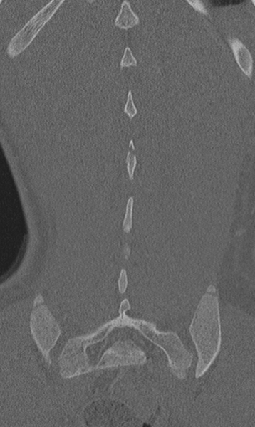 File:Chance fracture (Radiopaedia 40360-42912 Coronal bone window 59).png
