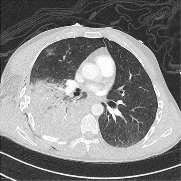 File:Chest and abdomen multi-trauma (Radiopaedia 26294-26425 lung window 55).jpg