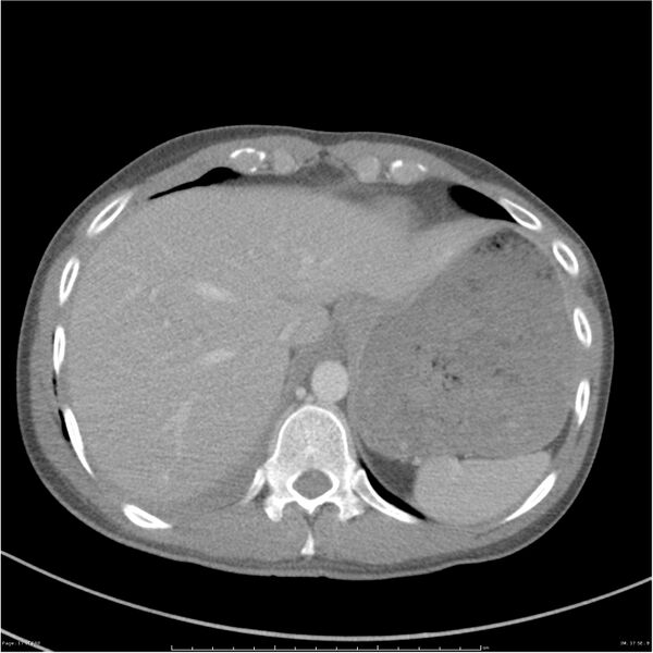 File:Chest and abdomen multi-trauma (Radiopaedia 26294-26426 bone window 17).jpg