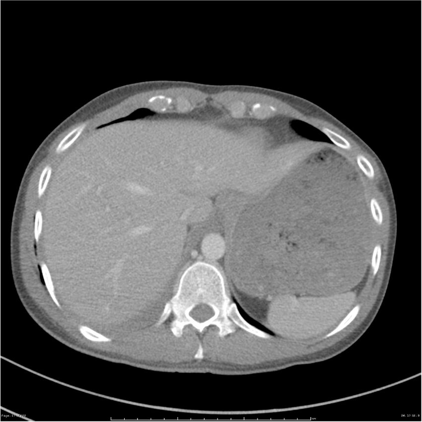 Chest and abdomen multi-trauma (Radiopaedia 26294-26426 bone window 17).jpg