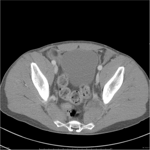 File:Chest and abdomen multi-trauma (Radiopaedia 26294-26426 bone window 74).jpg
