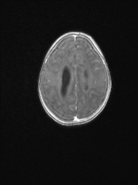 File:Chiari III malformation with occipital encephalocele (Radiopaedia 79446-92559 Axial T1 C+ mpr 65).jpg