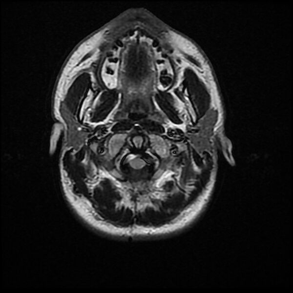 File:Chiasmatic-hypothalamic juvenile pilocytic astrocytoma (Radiopaedia 78533-91235 Axial FLAIR 2).jpg